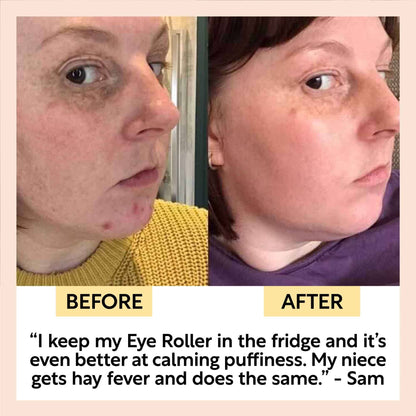 Eye Roller – Mot mørke ringer & hevelser | UpCircle
